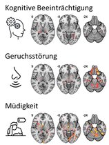 MRT-Bildre von Gehirnen mit Covid Schäden