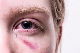 Person mit Verletzungen