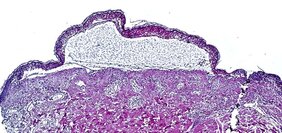 Aufnahme einer toxischen epidermalen Nekrolyse, die eine Ablösung der Epidermis zeigt. 