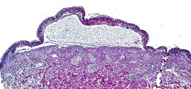 Aufnahme einer toxischen epidermalen Nekrolyse, die eine Ablösung der Epidermis zeigt. 