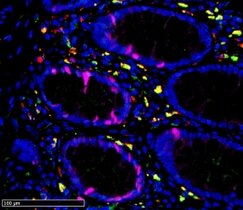 Immunfluoreszenzfärbung der Darmschleimhaut aus der Umgebung eines Darmtumors