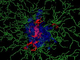 Entzündungsproteine (sogenannte ASC Specks, rot) im Kern einer Ansammlung von Amyloid-Beta-Peptiden (blau). Des Weiteren sind Immunzellen (grün) dargestellt. Computervisualisierung auf der Grundlage mikroskopischer Bilddaten. 