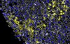 Mikroskopische Aufnahme einer menschlichen Leberbiopsie. Alpha-1 Aggregate in gelb, Leberzellen in grau mit blauem Zellkern. 
