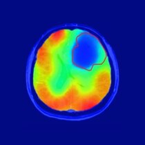 Die rote Linie markiert das Tumorareal; der farbige Kontrast zeigt den Sauerstoff-Stoffwechsel an. Wie vom Warburg-Theorem vorhergesagt, ist der Sauerstoff-Umsatz im Tumor reduziert (blau). 