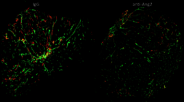 Histologische Aufnahme der Blutgefäße (grün) sowie der Lymphgefäße (orange) im Querschnitt eines Tumors.