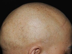 Ein Symptom des IFAP-Syndroms ist spärlicher Haarwuchs bis hin zu komplettem Haarverlust.