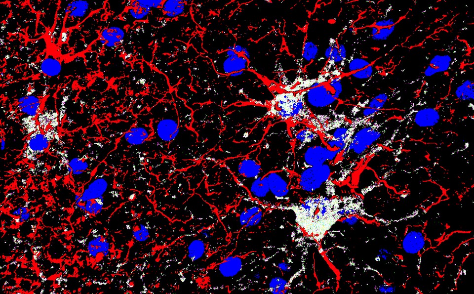 3D-Ansicht von reaktiven Astrozyten, die sich in unmittelbarer Nähe zu einer fokalen Blutung im menschlichen Gehirn befinden und Galectin 3 exprimieren.
