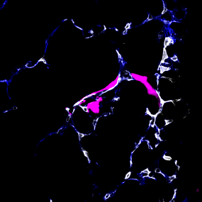 Metastasierende Krebszelle (pink) beim Verlasssen eines Blutgefäßes (Lunge) 